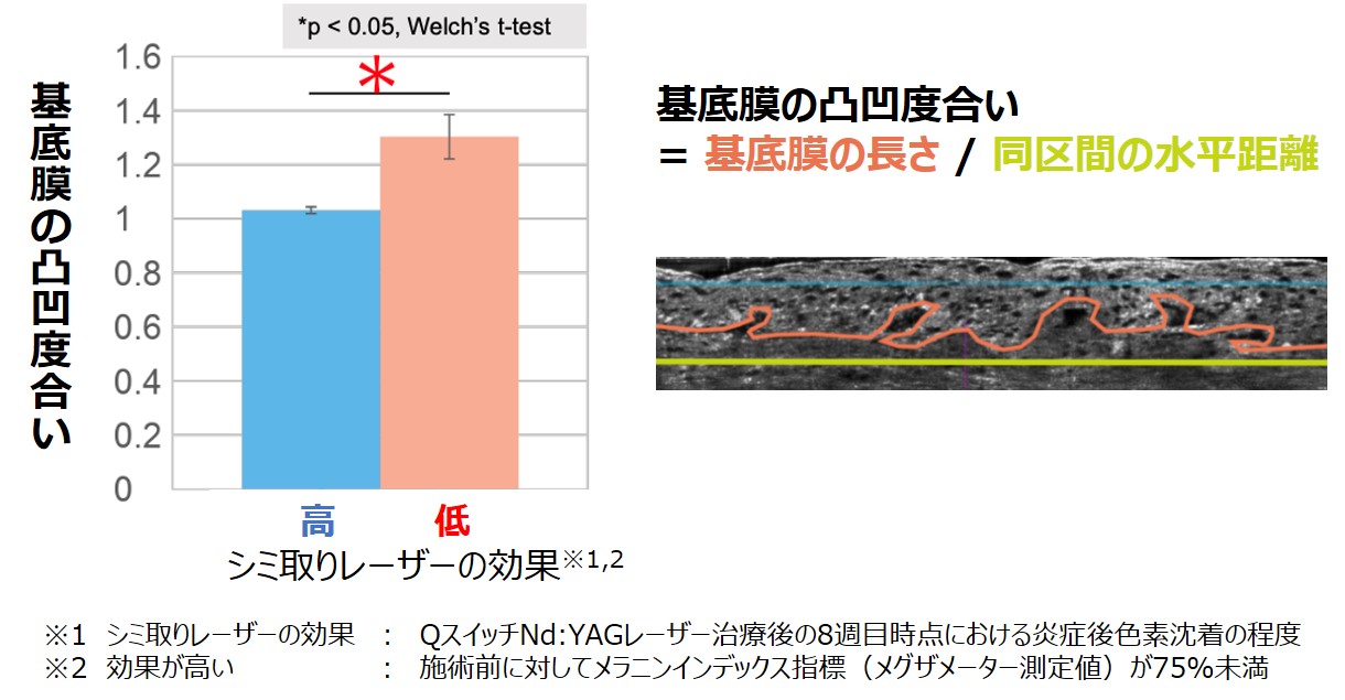 シミ取りレーザーの効果が 表皮の基底膜の凸凹度合いで変わることを発見 | ニュース | 株式会社コーセー